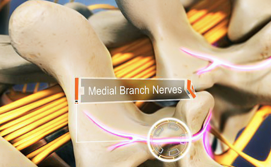 Back Pain: Can a Medial Branch Block Help?